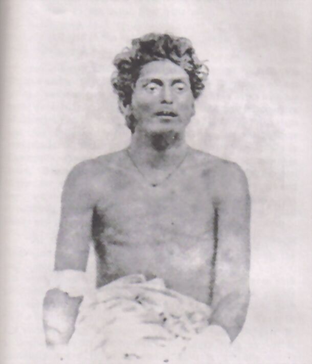 Photograph made after the confrontation of September 1915 showing Jatindranath Mukherjee, seated and bare-chested with a bandaged arm, gravely wounded.